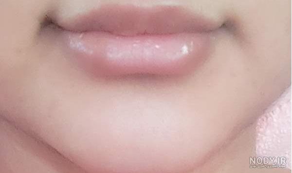 قیمت تزریق ژل لب نی نی سایت قیمت تزریق ژل لب نی نی سایت