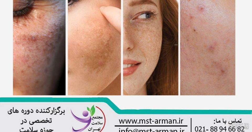 درمان لکه های هورمونی صورت درمان لکه های هورمونی صورت