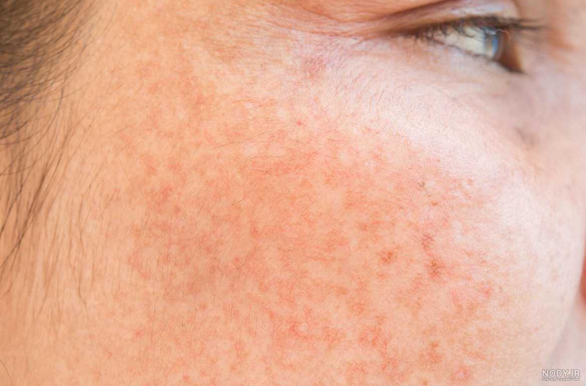 چه هورمونی باعث لک صورت میشود؟ - نیچرز پلنتی چه هورمونی باعث لک صورت میشود؟ - نیچرز پلنتی