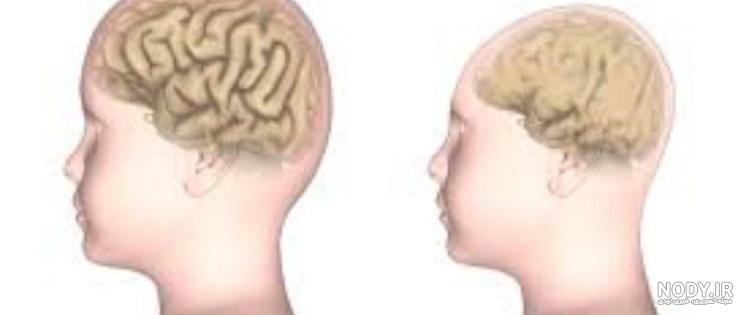 4 نوزاد تایلندی مشکوک به میکروسفالی ناشی از زیکا تشخیص داده شدند 4 نوزاد تایلندی مشکوک به میکروسفالی ناشی از زیکا تشخیص داده شدند