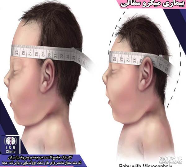 میکروسفالی و هر آنچه لازم است در مورد آن بدانید میکروسفالی و هر آنچه لازم است در مورد آن بدانید