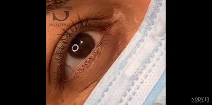 بن مژه و مراقبت های بعد از آن