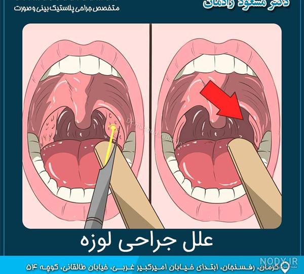 بزرگی لوزه سوم و کم شنوایی در کودکان | علل، تشخیص و درمان لوزه سوم بزرگی لوزه سوم و کم شنوایی در کودکان | علل، تشخیص و درمان لوزه سوم