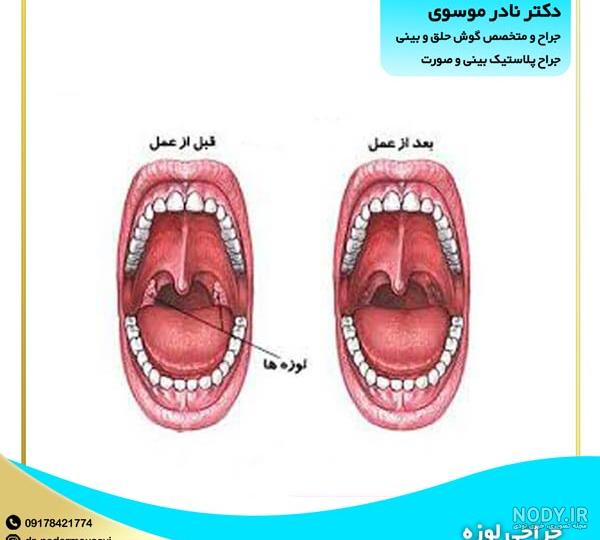 جراحی لوزه | متخصص جراحی پلاستیک بینی و صورت | دکتر مسعود رادمان