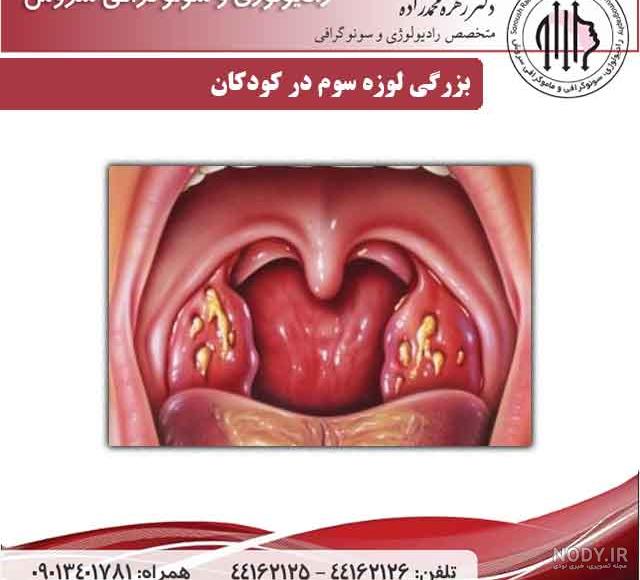 سنگ لوزه و بهترین درمان موثر آن چیست؟ | پذیرش۲۴
