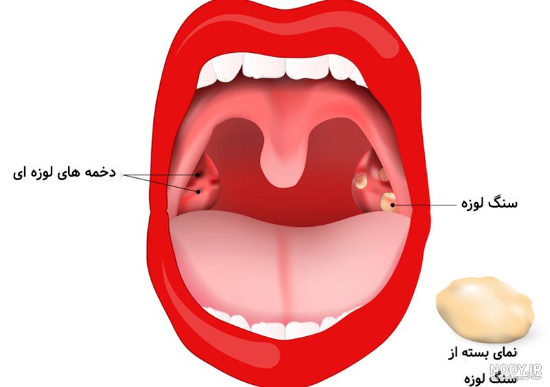 سنگ لوزه چیست، چگونه ایجاد می شود و برای درمان چه باید کرد؟ (+عکس)