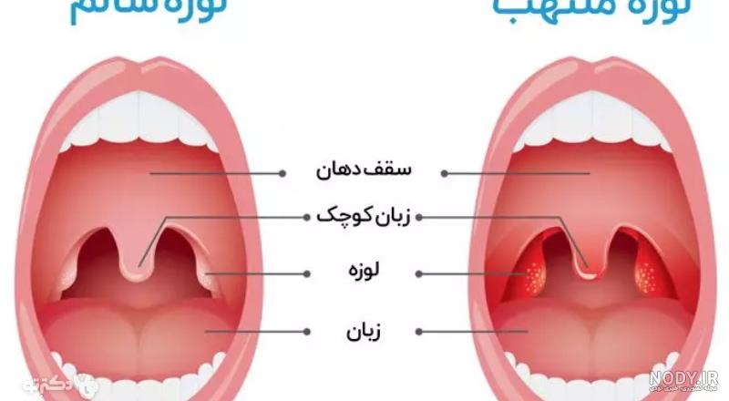عکس لوزه