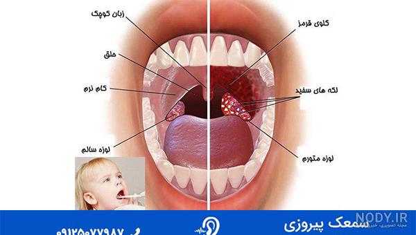 عکس لوزه سوم