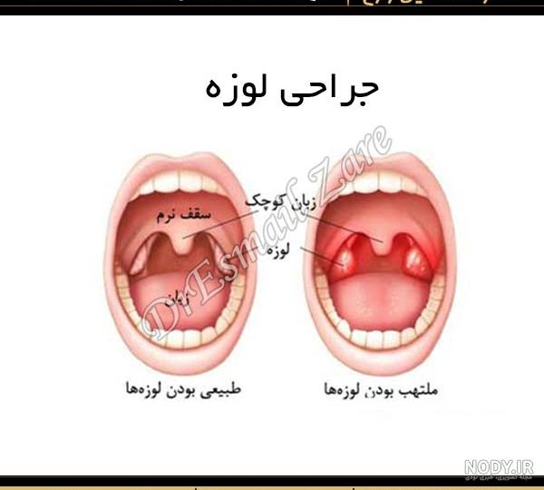 عکس لوزه چرکی