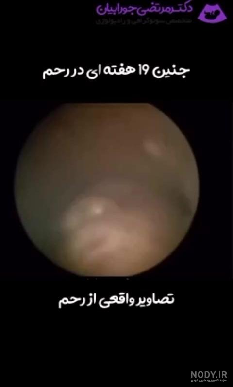 عکس جنین پسر در 20 هفتگی - عکس نودی
