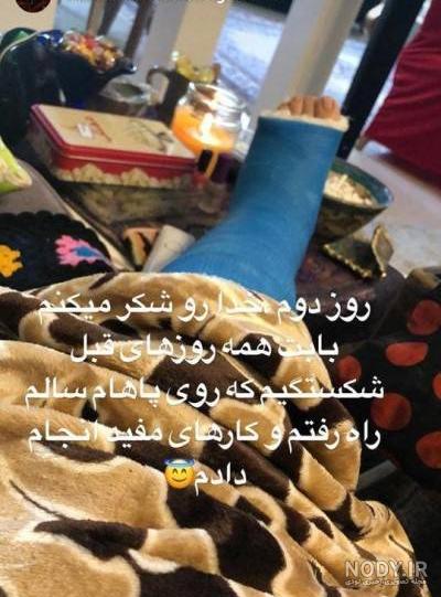 عکس دسته شکسته گچ گرفته دختر - عکس نودی