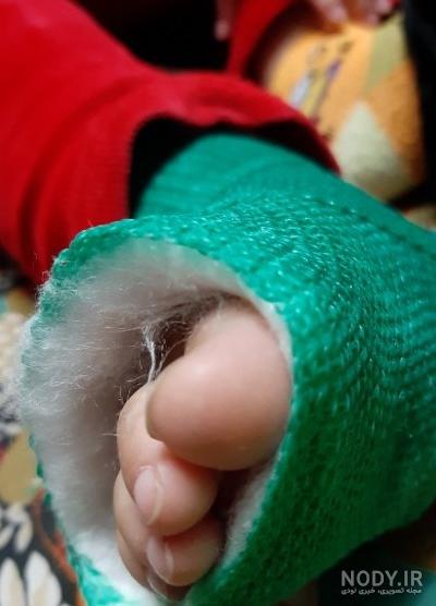 عکس فیک پا شکسته دختر