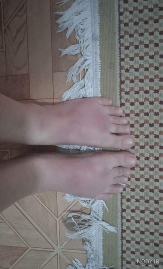 عکس فیک پا شکسته دختر