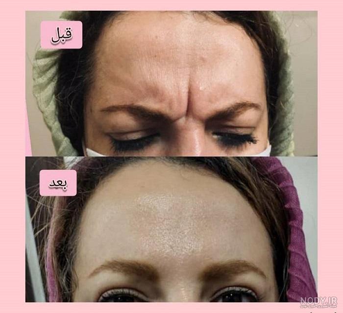 بوتاکس پیشانی و مزایا و معایب آن - مراقبتهای بعد از بوتاکس پیشانی ...