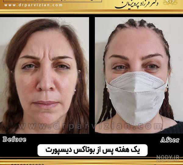 بوتاکس پیشانی در مشهد ؛ هزینه بوتاکس پیشانی در مشهد + دوز مناسب ...