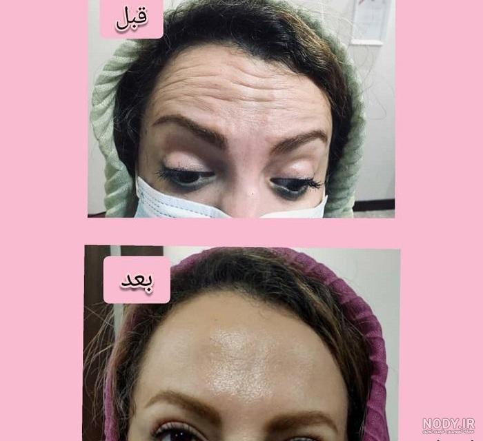 بوتاکس پیشانی در مشهد ؛ هزینه بوتاکس پیشانی در مشهد + دوز مناسب ...