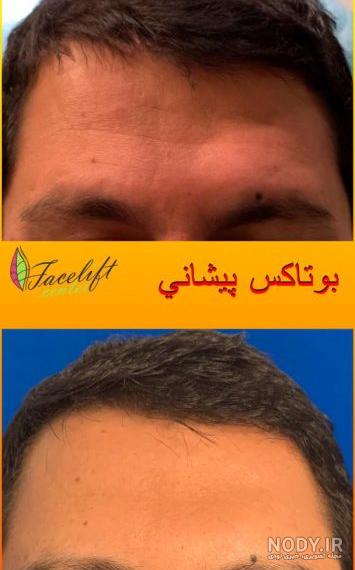 تزریق بوتاکس صورت و پیشانی + لیست قیمت بوتاکس و فیلم، عکس