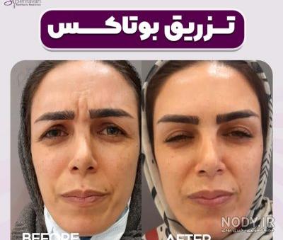 تزریق بوتاکس پیشانی و دور چشم زنان و مردان بهمراه عکس و فیلم ...
