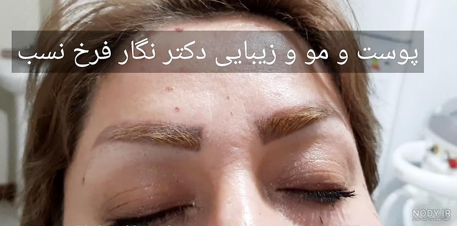 تزریق بوتاکس پیشانی؛ رفع چروک پیشانی با بوتاکس