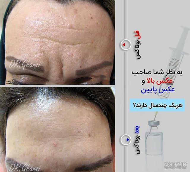 تصاویر تزریق ژل بوتاکس چربی | تزریق ژل | تزریق بوتاکس | تزریق چربی ...