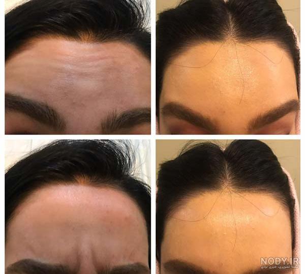 عکس از بوتاکس پیشانی