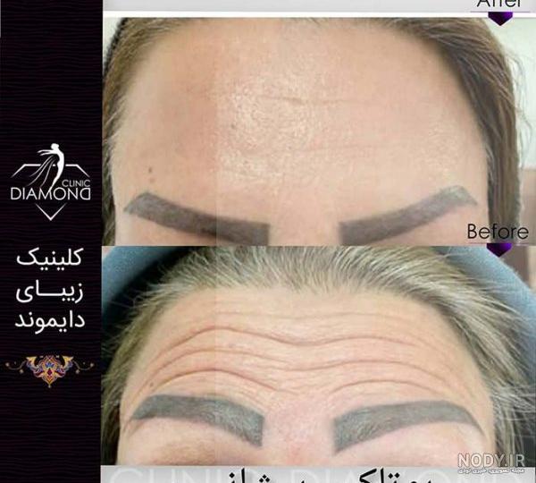 عکس بوتاکس پیشانی