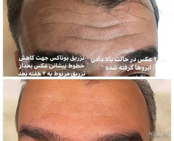 عکس بوتاکس چشم و ابرو