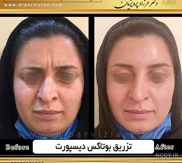 عکس عوارض بوتاکس پیشانی