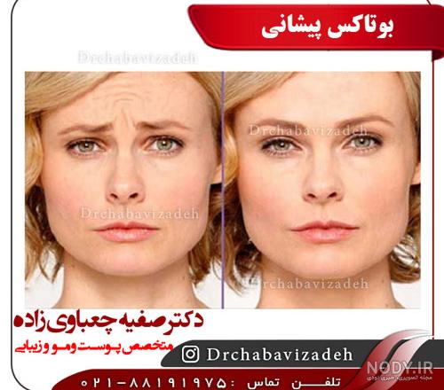 عکس قبل و بعد بوتاکس پیشانی