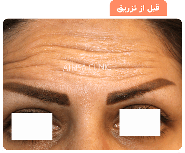 گالری تصاویر تزریق بوتاکس