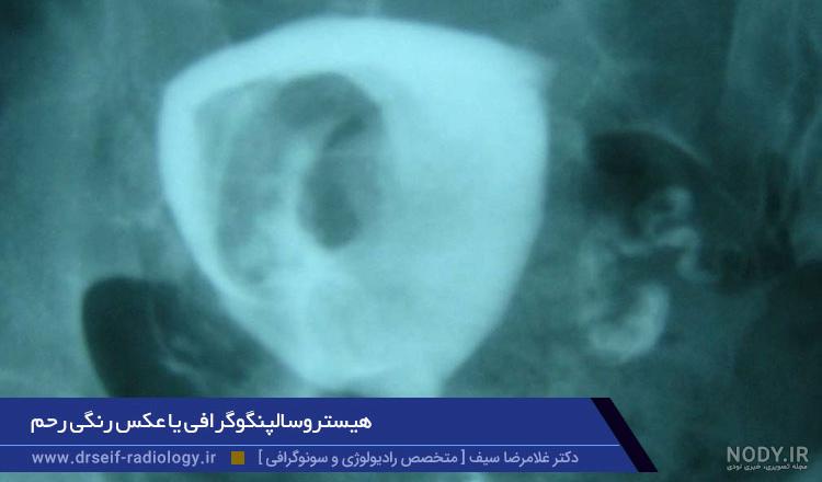 عوارض بعد از عکس رنگی رحم نی نی سایت عوارض بعد از عکس رنگی رحم نی نی سایت