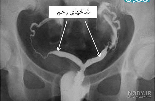 عوارض عکس رنگی رحم عوارض عکس رنگی رحم