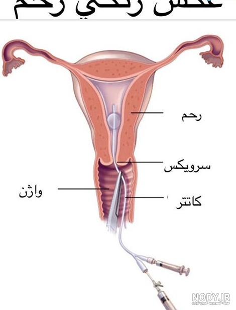 عکس رنگی رحم عوارض عکس رنگی رحم عوارض