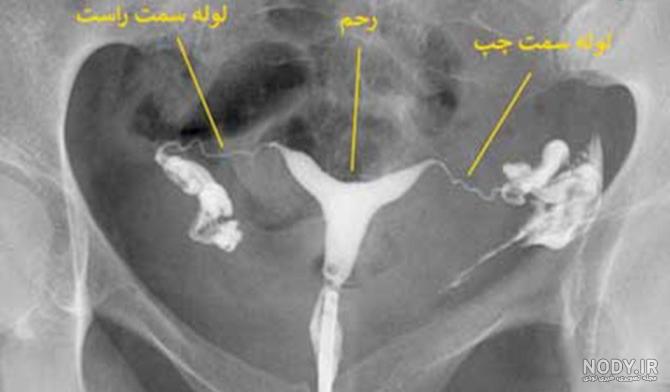 عکس رنگی رحم، خطرات و عوارض عکس رنگی رحم، خطرات و عوارض
