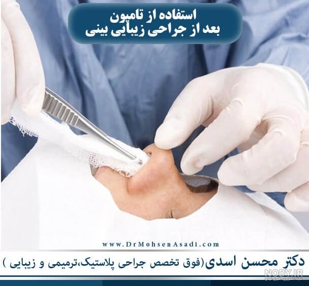 تامپون بینی چیست | مراقبت ها و نحوه برداشت - دکتر فرشته عبدالمطلبی تامپون بینی چیست | مراقبت ها و نحوه برداشت - دکتر فرشته عبدالمطلبی