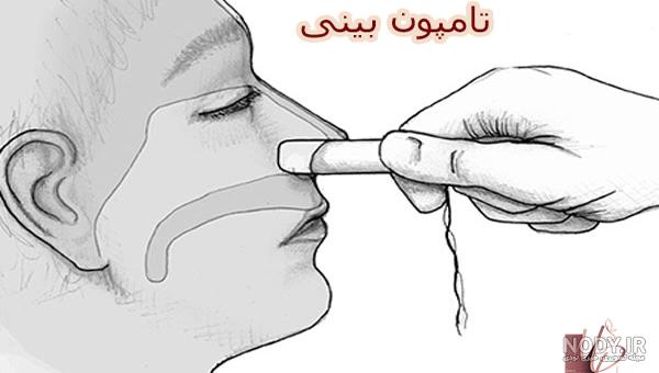 درآوردن مش داخل بینی پس از جراحی زیبایی بینی درآوردن مش داخل بینی پس از جراحی زیبایی بینی
