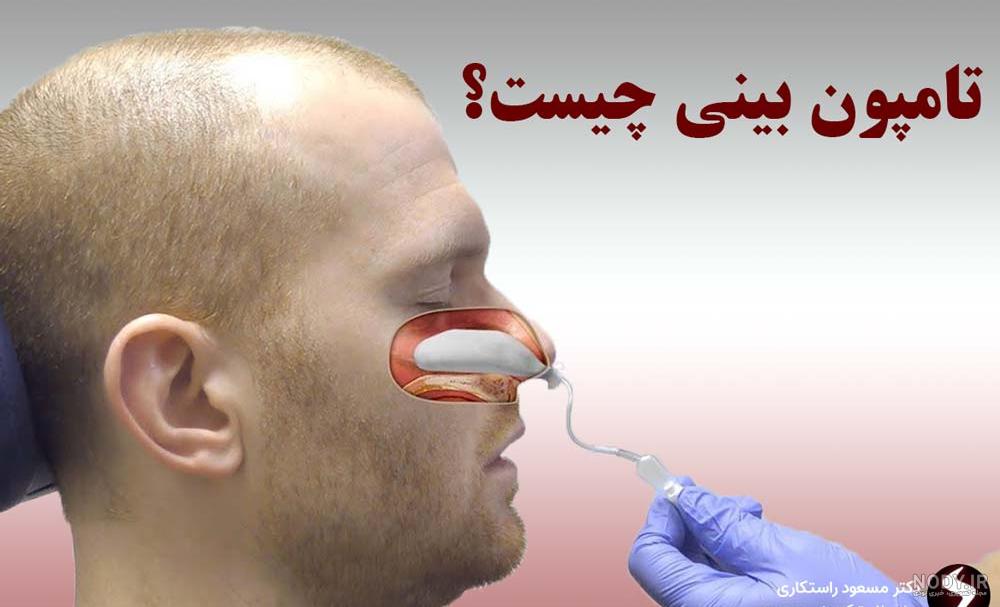 عکس تامپون در بینی عکس تامپون در بینی