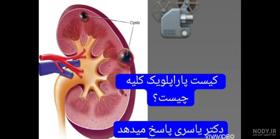 عکس ساده کلیه (KUB) و 3 کاربرد اصلی آن: می دانید سنگ کلیه از عکس ساده کلیه (KUB) و 3 کاربرد اصلی آن: می دانید سنگ کلیه از