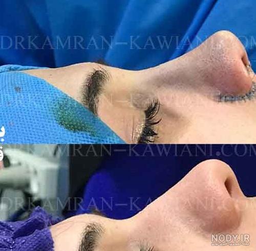 عکس دختر زیبا دماغ عملی - عکس نودی