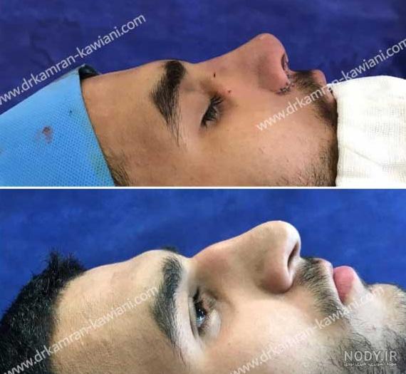 عکس پسر دماغ عملی خوشگل - عکس نودی
