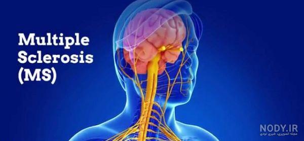 روز جهانی ام اس | World MS Day روز جهانی ام اس | World MS Day
