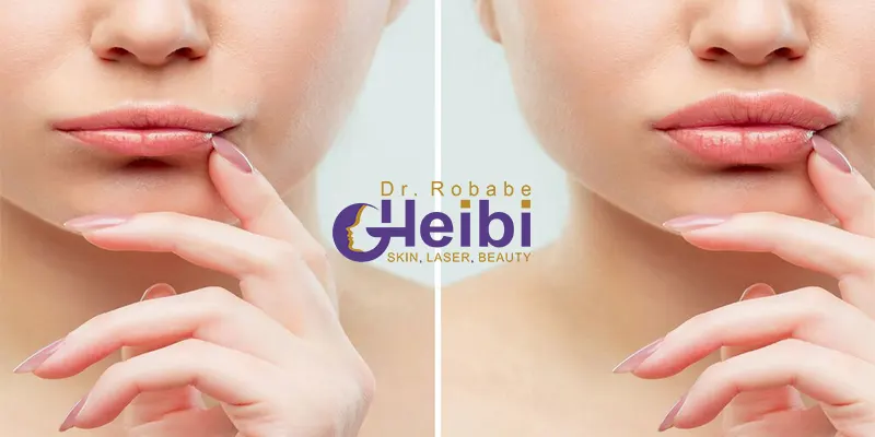 عکس تزریق ژل لب دو سی سی عکس تزریق ژل لب دو سی سی