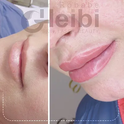 عکس تزریق ژل لب نیم سی سی عکس تزریق ژل لب نیم سی سی