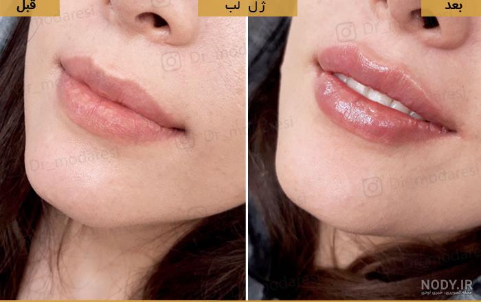 عکس تزریق ژل لب یک سی سی عکس تزریق ژل لب یک سی سی