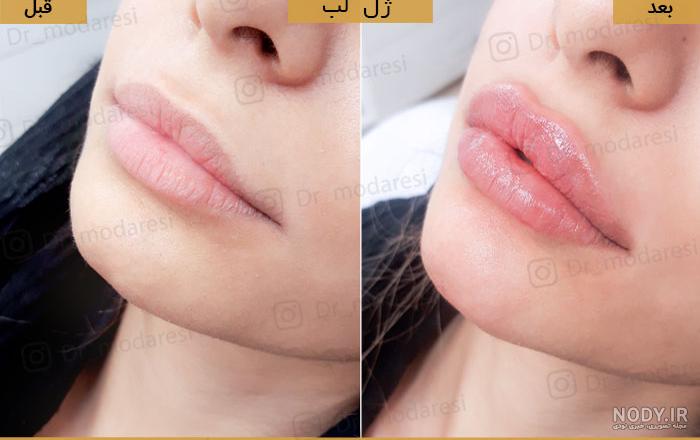 عکس لب بعد از تزریق ژل عکس لب بعد از تزریق ژل