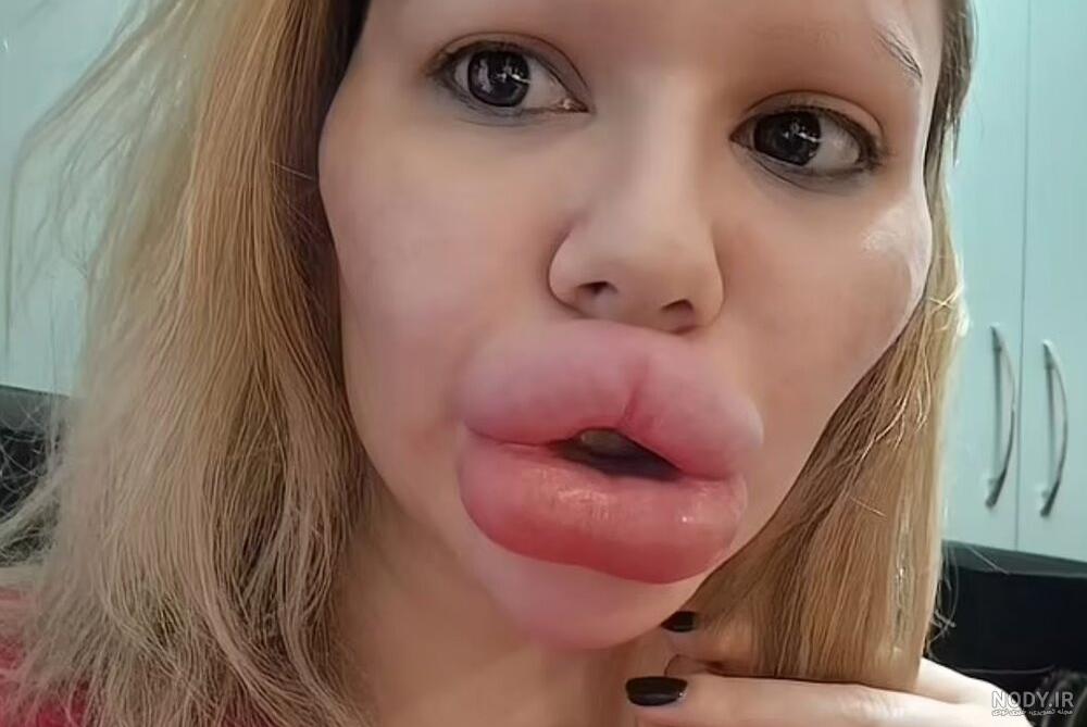 عکس لب ژل تزریق شده عکس لب ژل تزریق شده