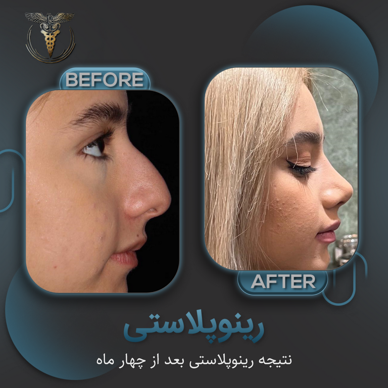 جراحی کم تهاجمی بینی بعد از دوهفته , 🔸دکتر بنیامین رحمتی, Preservation  Rhinoplasty, Two weeks Post-Op, ‏@dr_benyaminrahmaty , 🔹متخصص گوش و حلق و  بینی , 🔹جراحی زیبایی بینی و صورت , 🔹جراح سر و گردن , ...