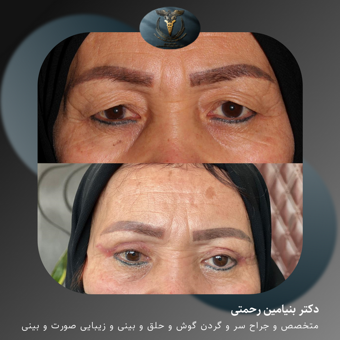 دکتر بنیامین رحمتی | جراح زیبایی بینی و صورت‎ | ‎✔️نتیجه جراحی ...