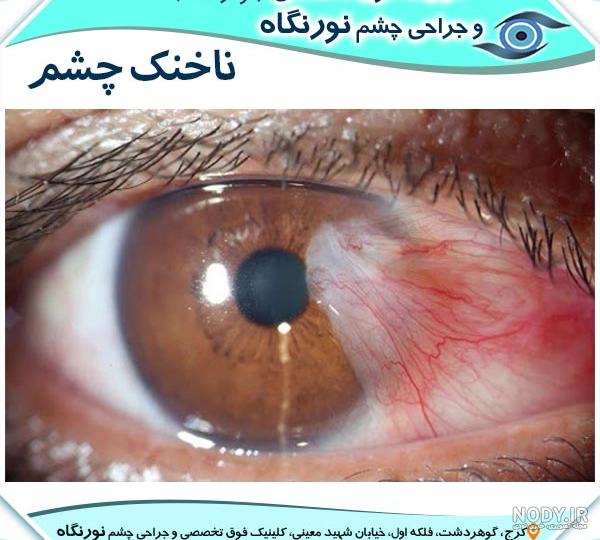 عکس بچه یک چشم عکس بچه یک چشم
