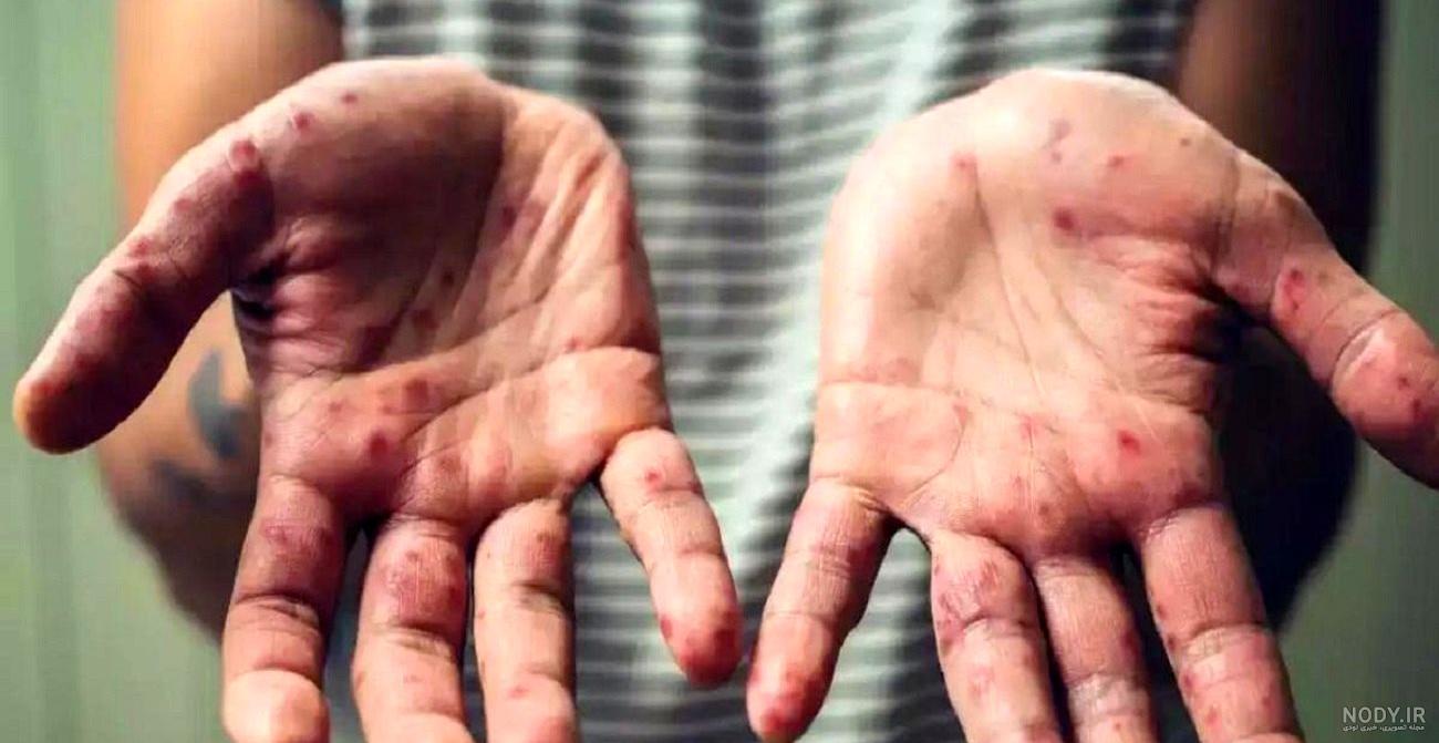 آبله میمون با چه روشهایی به انسان انتقال پیدا می کند | مارال نیوز